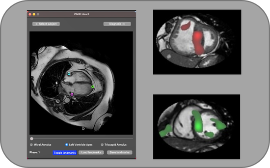 Interpretable ML for Cardiac MRI